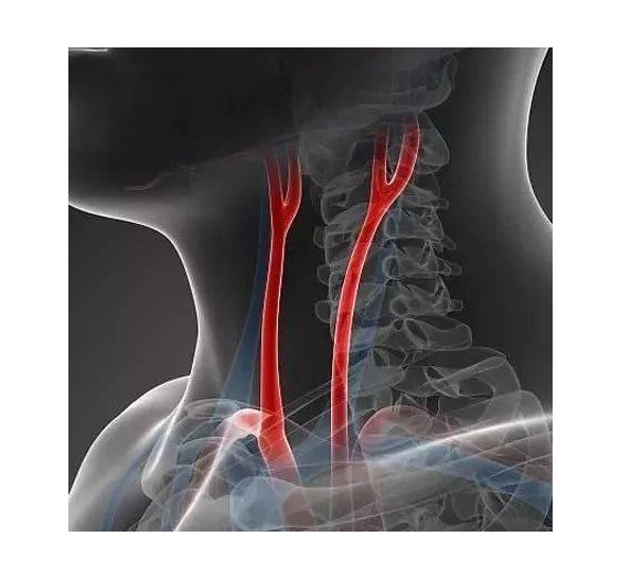 颈动脉疾病