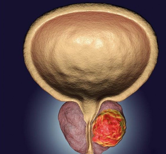 前列腺癌