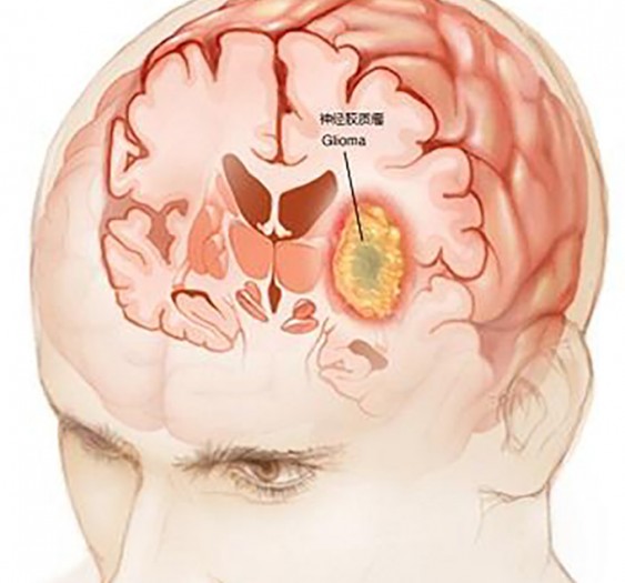 神经胶质瘤