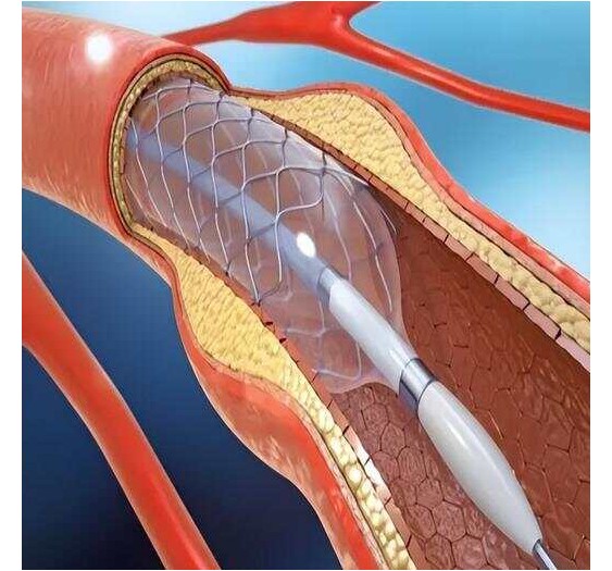 血管造影、血管成形术和支架置入术