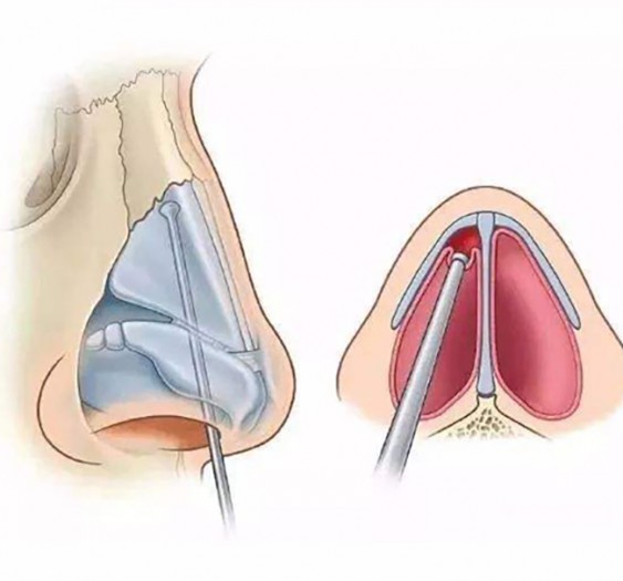 鼻中隔成形术