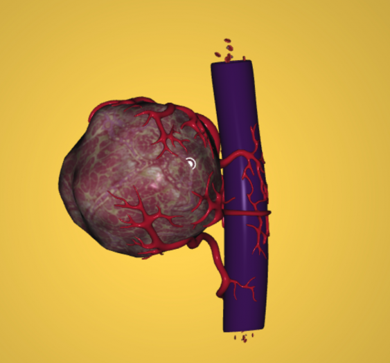 血管肿瘤 Vessel Tumor
