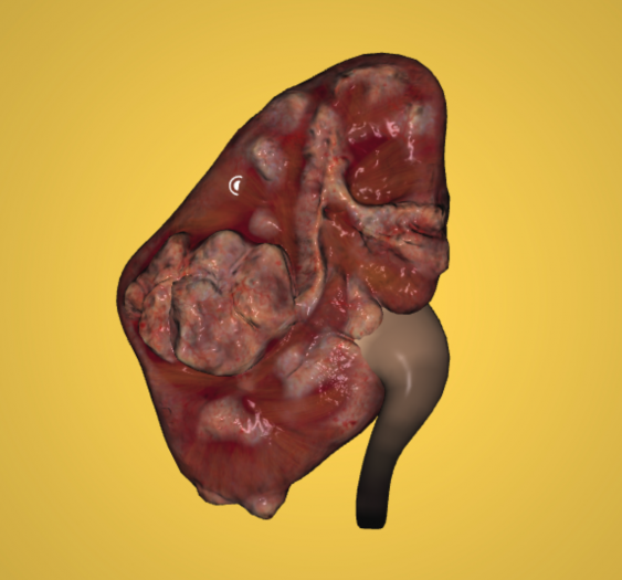 肾细胞癌 Renal Cell Carcinoma