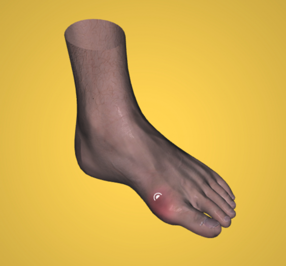 痛风 Gout
