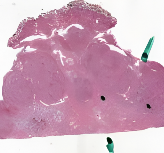 肝脏局灶性结节增生