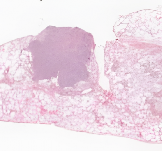 肺单纯性鳞状细胞癌