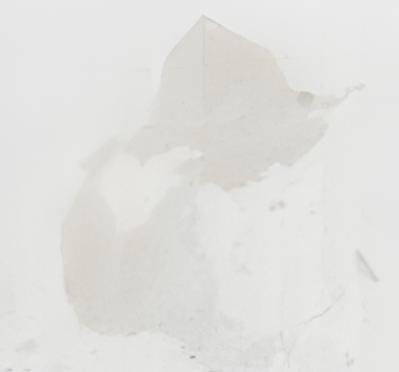 左侧胸腔积液浆细胞紊乱