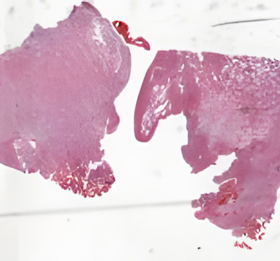 脑毛细胞性星形细胞瘤