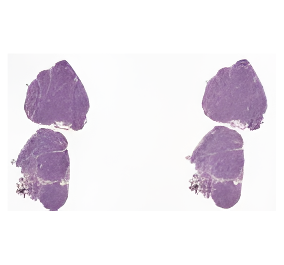 淋巴结病浆细胞变异体