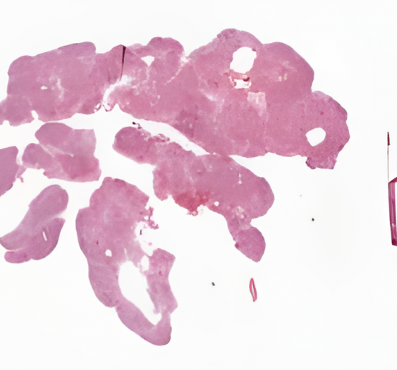 第四心室室管膜下瘤