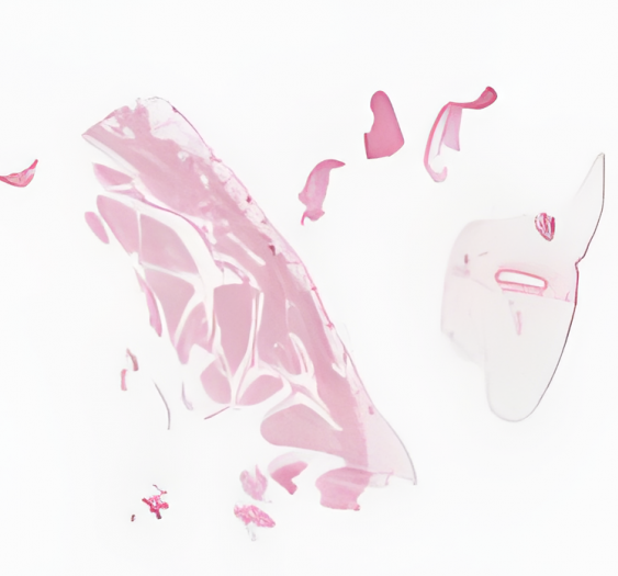 心脏，急性风湿性心脏病