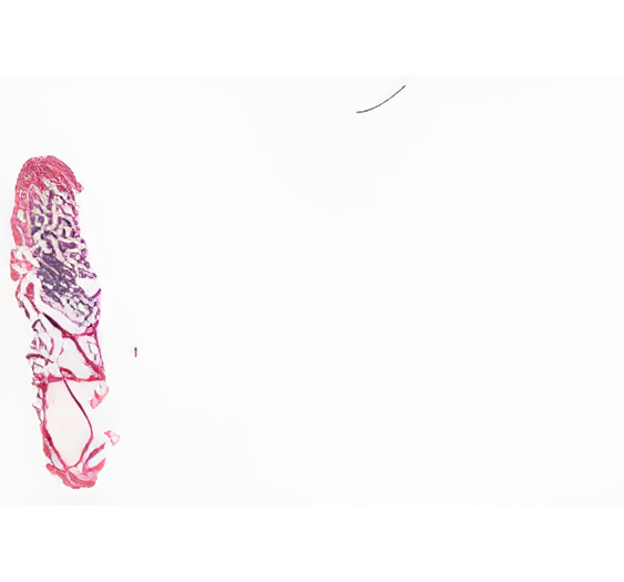 骨髓增生异常综合征