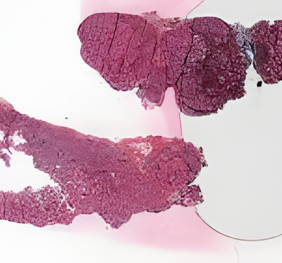 肉芽肿性甲状腺炎