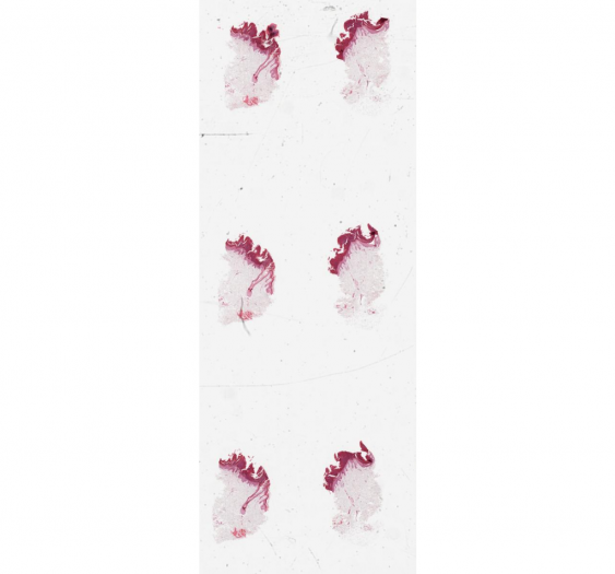 腋窝颗粒状角化不全症