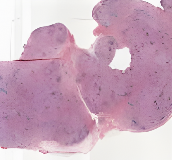 特发性窦组织细胞增生性巨淋巴结病