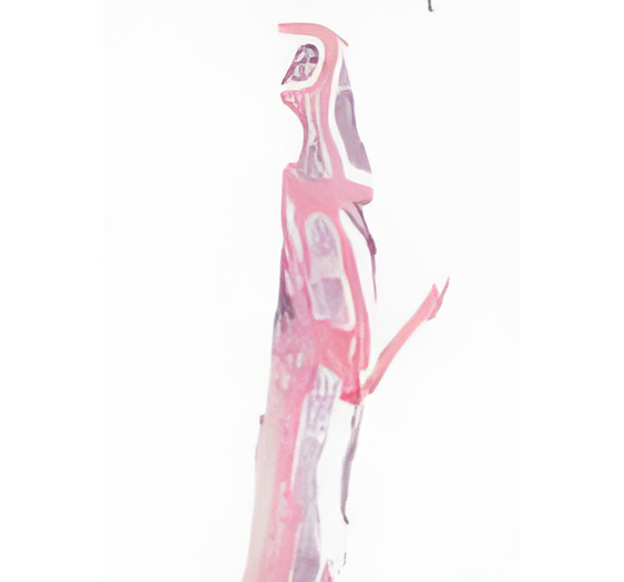 血红素，伯基特淋巴瘤