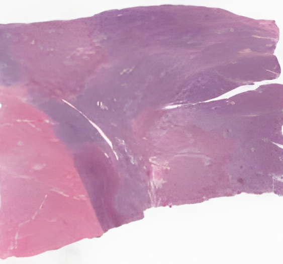 弥漫性大B细胞淋巴瘤