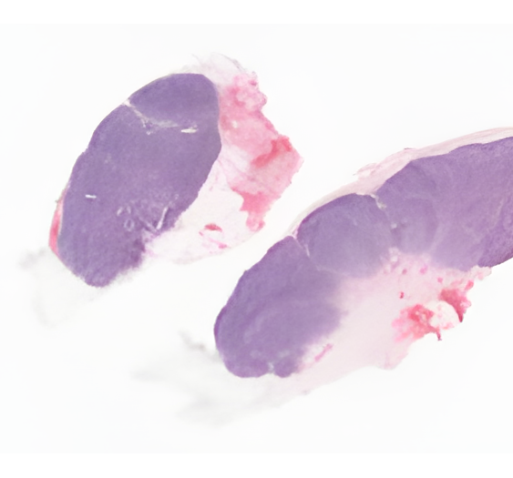 血红素，反应性滤泡淋巴增生