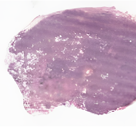 酸性粒细胞增多性淋巴肉芽肿