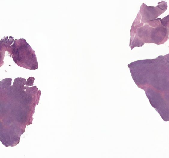 淋巴结霍奇金病，结节性硬化