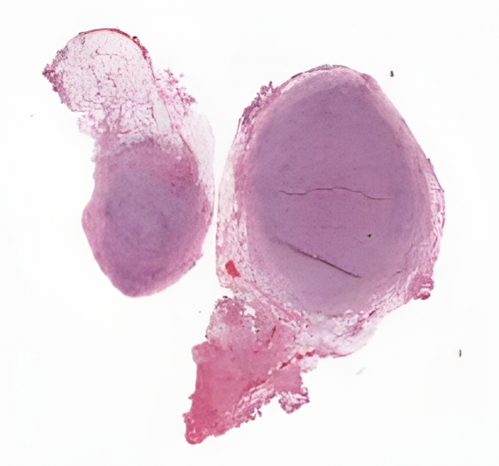 淋巴管内分枝杆菌