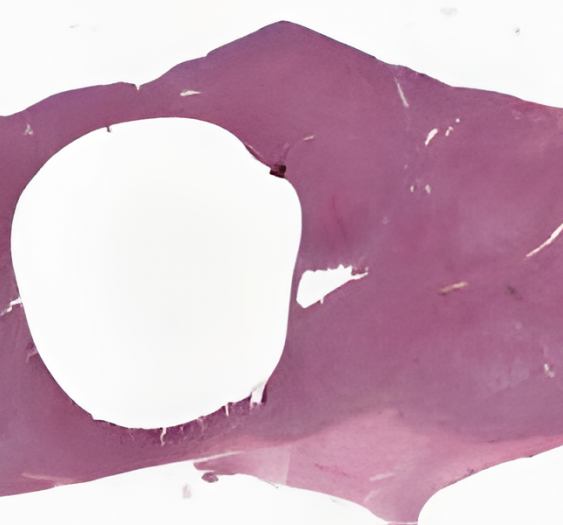 脾脏慢性粒细胞白血病