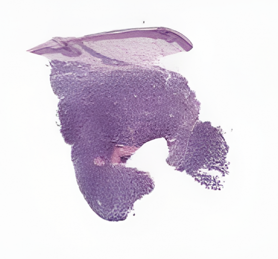 多发性骨髓瘤-1