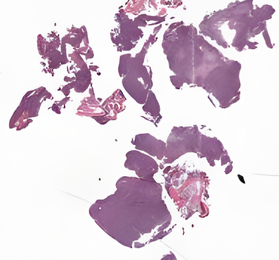 股骨远端大B细胞淋巴瘤