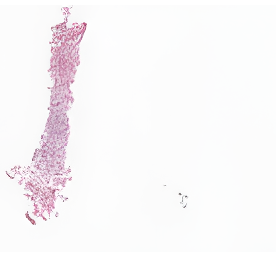 骨髓，浆细胞性骨髓瘤