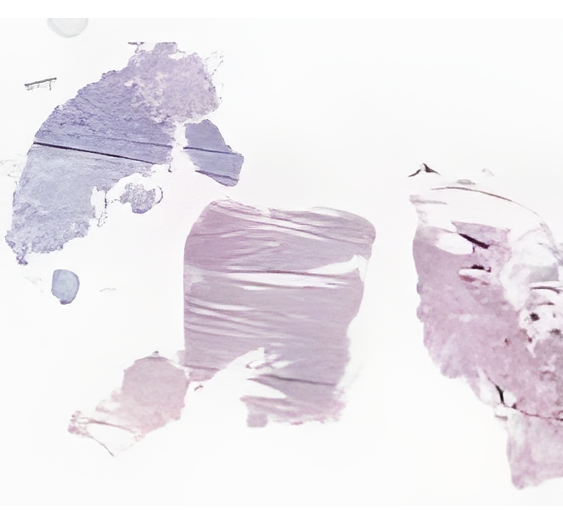 冰冻组织，浆细胞瘤