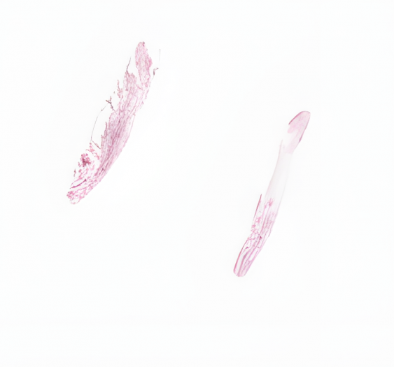 弥漫性大B细胞淋巴瘤