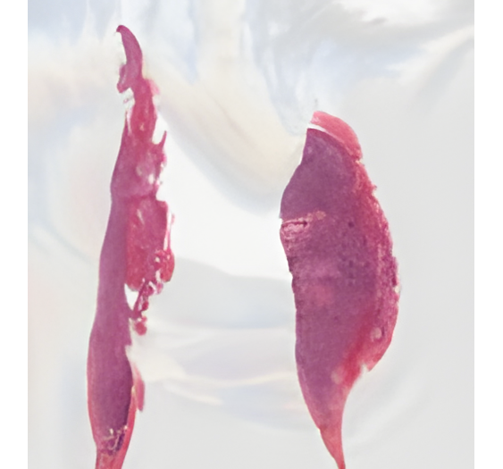 嗜酸性粒细胞增多的大B细胞淋巴瘤