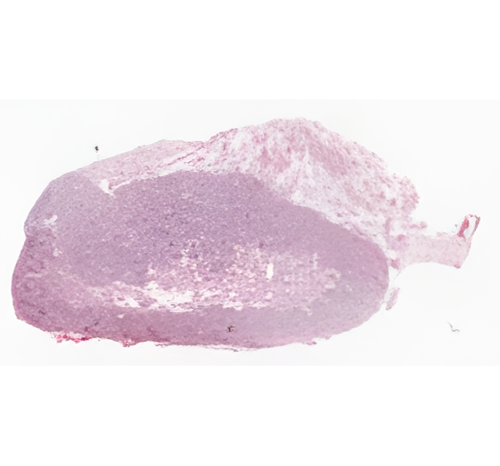 噬血细胞性淋巴组织细胞增多症