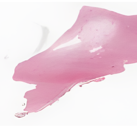 基底细胞瘤与巨细胞成纤维细胞瘤