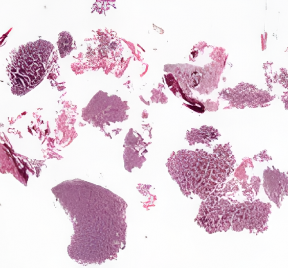 骨纤维异常增殖症