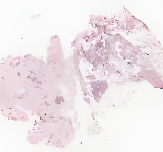 膝关节焦磷酸钙沉积病