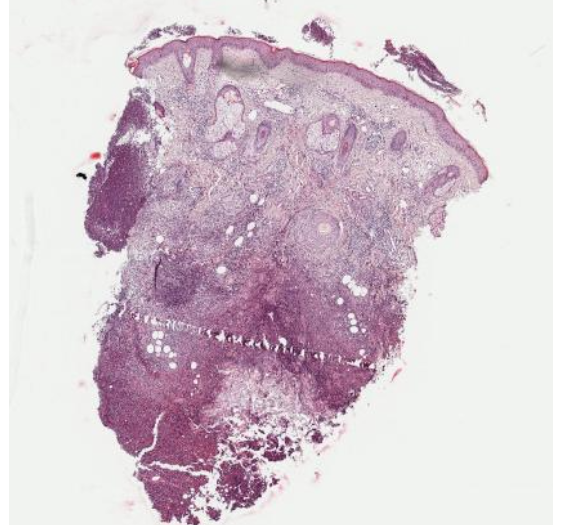 α1-抗胰蛋白酶缺乏症