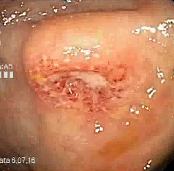 结肠炎