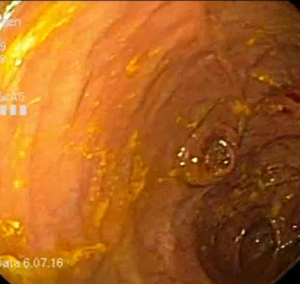 克罗恩病