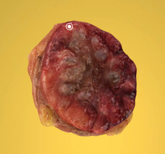 膀胱上皮瘤Bladder - Epithelioma