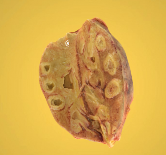 弥漫性结核性肾炎