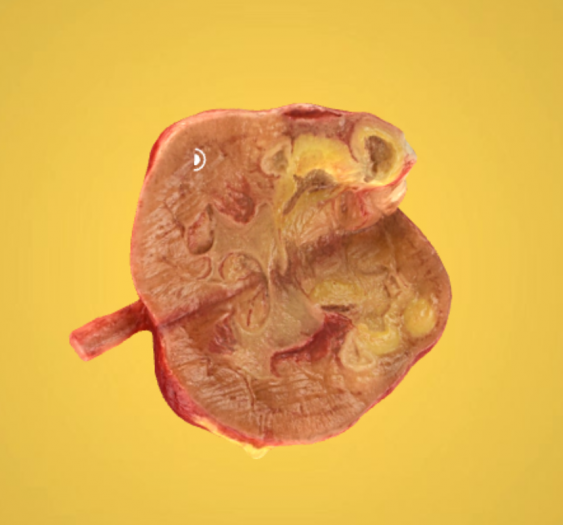 肾结核性肾炎
