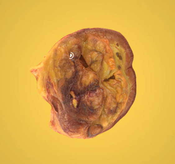 肾脏-腺癌