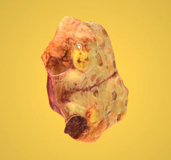 肾脏-腺癌
