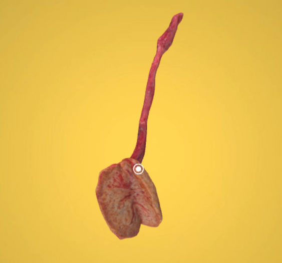 萎缩性肾脏_动脉硬化症