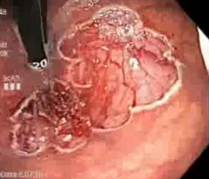 直肠息肉