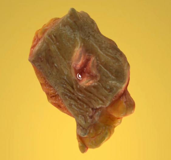 结肠腺癌