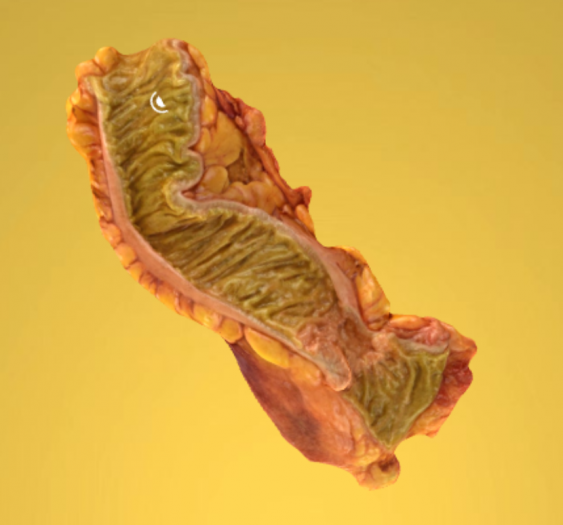 结肠腺癌