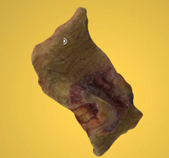 梗阻性结肠腺癌