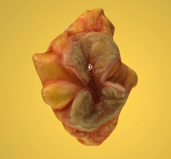 梗阻性结肠腺癌